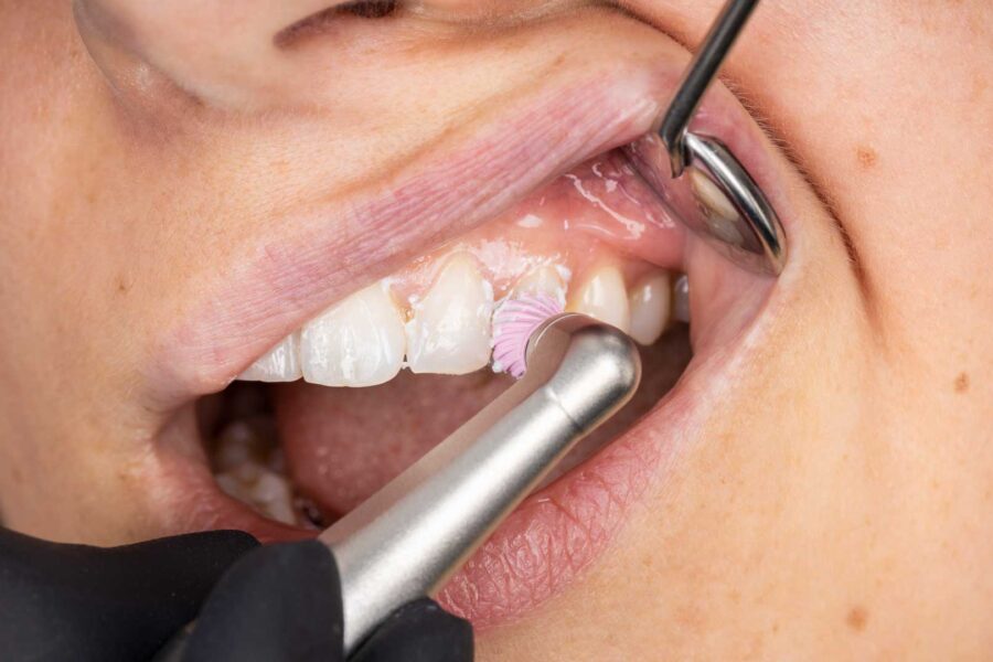 Prophylaxie dentaire (prévention)