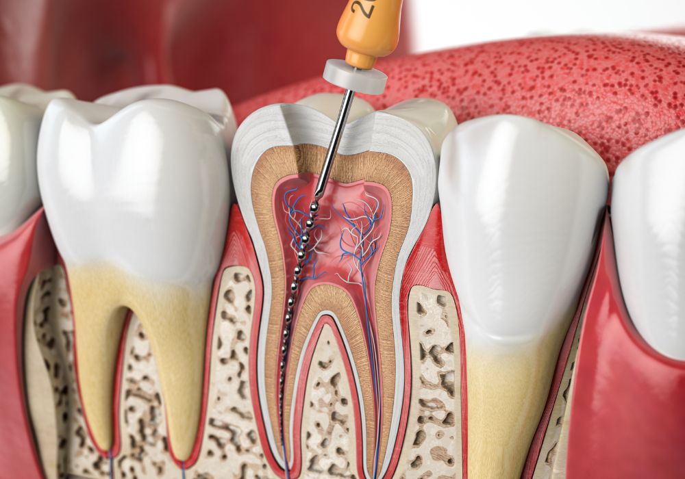 Endodontie (traitement canalaire)