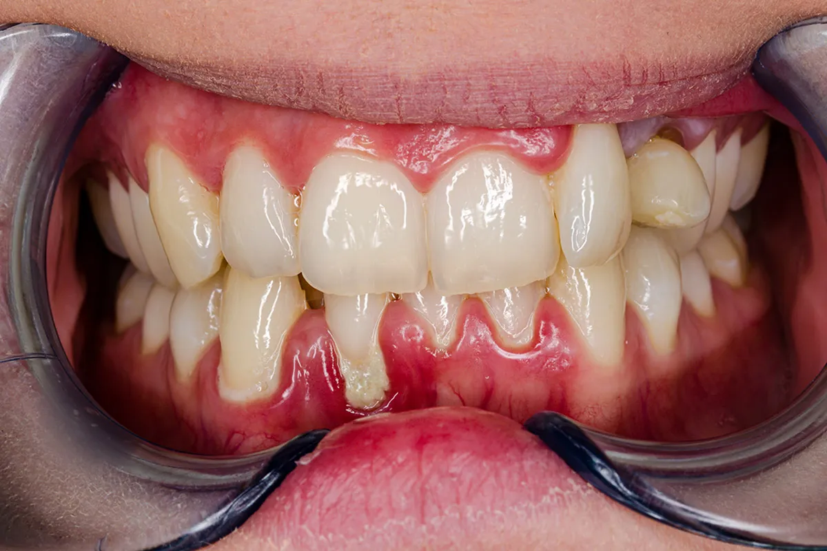 Traitement gingival