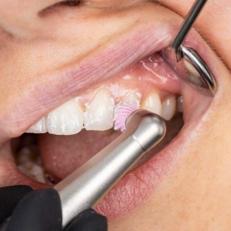 Prophylaxie dentaire (prévention)