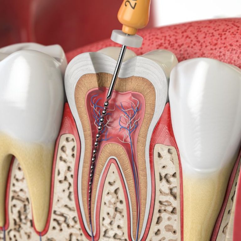 Endodontie (traitement canalaire)