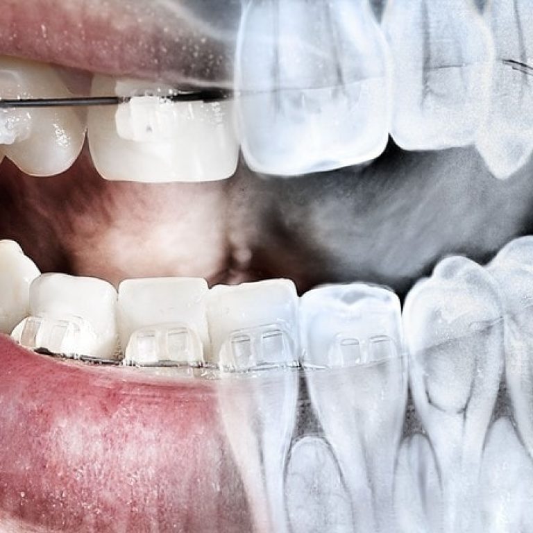 Radiographie dentaire