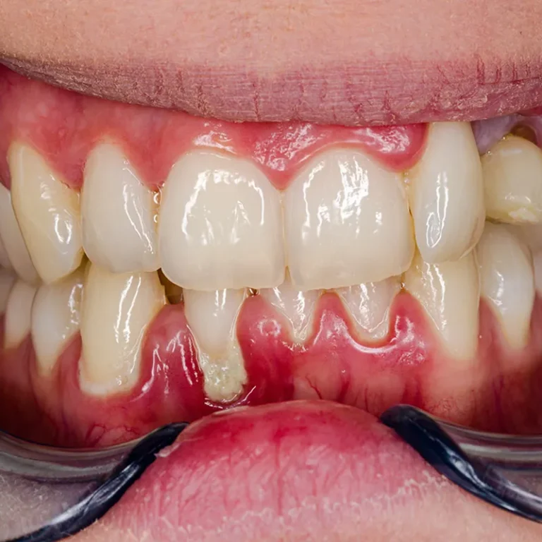 Traitement gingival